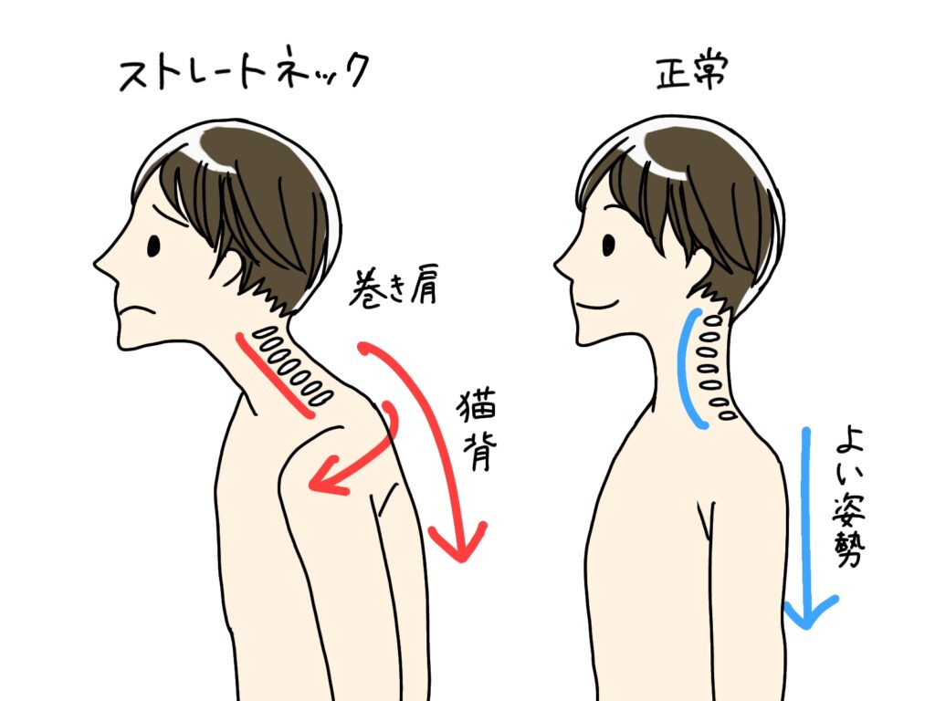 ストレートネック